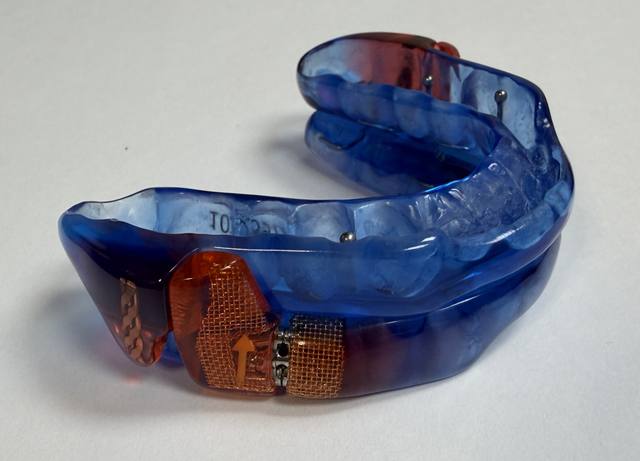 Dorsal oral appliance for sleep apnea fitted at Argyle Dental Sleep and TMJ